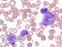 MPN JAK2-PCM1-Biopsy HE