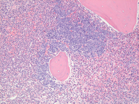 MPN-JAK2PCM1Biopsy-HE