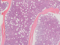 MPNPolycythemia-Vera