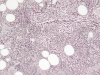 MPNPolycythemia-Vera