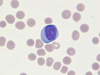 TProlymphocytic-leukemia
