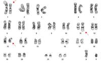 APLkaryotype