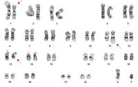 APL-karyotype