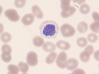 Blastic plasmacytoid dendritic cell neoplasm involving marrow