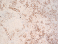 Lymphomatoid-granulomatosisCD20