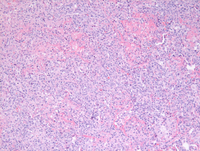 Lymphomatoid granulomatosis