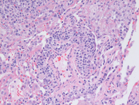 Lymphomatoid granulomatosis