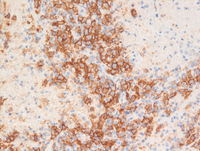 Lymphomatoid granulomatosis