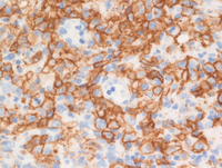 Lymphomatoid-granulomatosisCD20