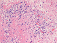 Lymphomatoid-granulomatosisHE