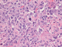 Lymphomatoid granulomatosis, grade 3