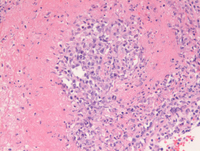 Lymphomatoid-granulomatosisHE