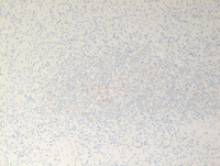 Splenic-marginal-zone-lymphomaCD20