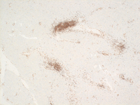 Splenic marginal zone lymphoma-CD79a