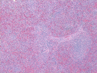 Splenic marginal zone lymphoma-HE