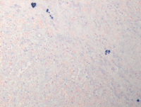 Splenic-marginal-zone-lymphomaLambda-ISH