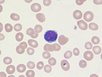 Mantle-cell-lymphomaBlood