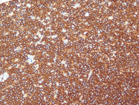 Mantle-cell-lymphomaCD20