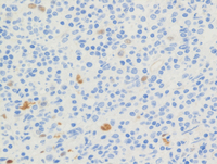 Mantle-cell-lymphomaCyclinD1