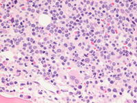 Mantle-cell-lymphoma