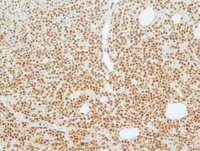 Mantle cell lymphoma-PAX5