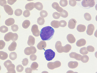 Mantle-cell-lymphoma