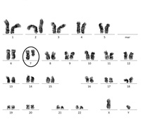 Deletion 7q in adult AML