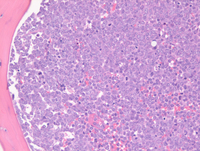 Myeloid-NeoplasmGATA2Pedigree