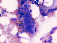 Myeloid-NeoplasmGATA2Pedigree