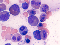 Myeloid-NeoplasmGATA2Pedigree