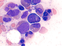 Myeloid-NeoplasmGATA2Pedigree