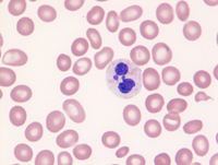 Myeloid-NeoplasmGATA2Pedigree