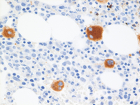 Myeloid-NeoplasmGATA2Pedigree