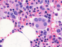 Myeloid-NeoplasmGATA2proband