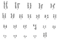 Myeloid-NeoplasmGATA2Pedigree