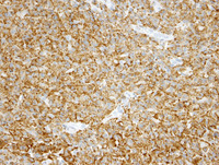 Histiocytic sarcoma-CD68