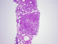 Histiocytic sarcoma-HE