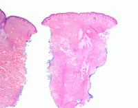 Erdheim-Chester Disease