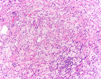 ErdheimChester-Disease