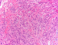 ErdheimChester-Disease