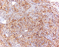 ErdheimChester-DiseaseCD68