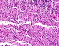 Indeterminate dendritic cell tumor