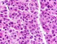 Indeterminate-dendritic-cell-tumor