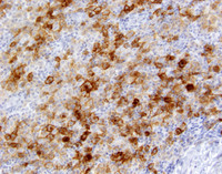 Indeterminate dendritic cell tumor-CD1a