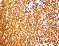 Indeterminate dendritic cell tumor-S100
