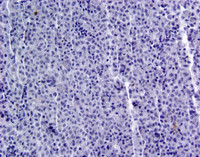 Indeterminate dendritic cell tumor-Langerin