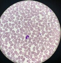 Babesia parasites on peripheral blood smear 3