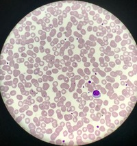 Babesia parasites on peripheral blood smear 4