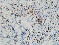 Current-WHO-2016-Classification-of-EBV-Tcell-and-NKcell-Proliferations