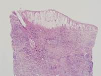 Current-WHO-2016-Classification-of-EBV-Tcell-and-NKcell-Proliferations